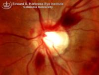 Splinter Optic Disc Hemorrhages